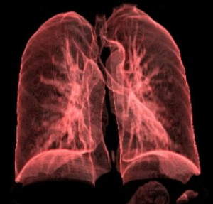 lung cancer