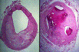 Cross Sections of Atherosclerotic Arteries
Cross Sections of Atherosclerotic Arteries